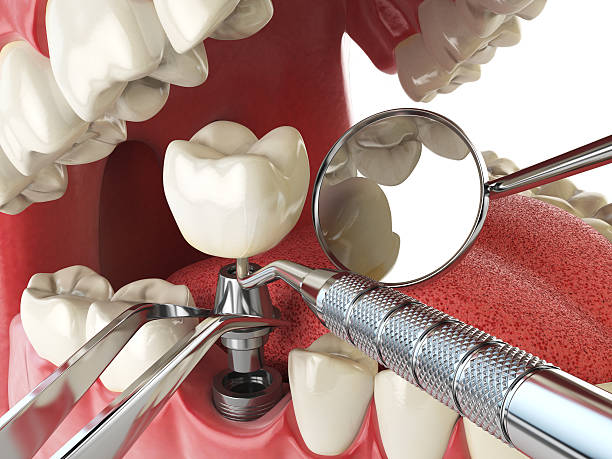 Best Emergency Treatment for Dental Infections or Abscesses in Rolesville, NC